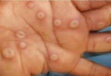 MINISTÉRIO DA SAÚDE EM ANGOLA PREOCUPADO COM SURTO DE VARÍOLA DO MACACO NA RDC E REPÚBLICA DO CONGO